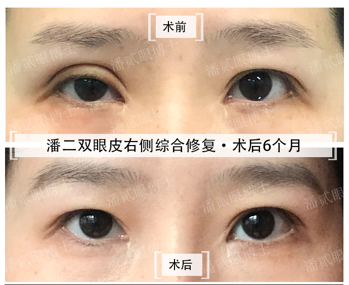 双眼皮修复具体要问什么,双眼皮修复过程中关注事项