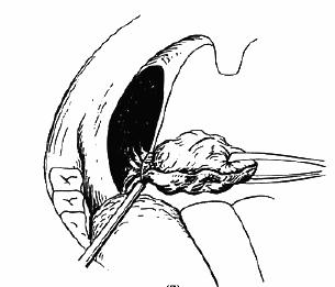 扁桃体切除会影响以后的免疫力吗,扁桃体切除后对免疫力有影响吗