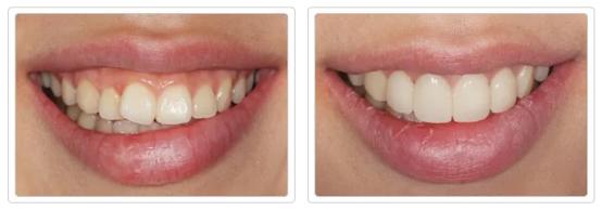 什么方法最适合去黄牙不伤牙齿,一口老黄牙怎么治疗