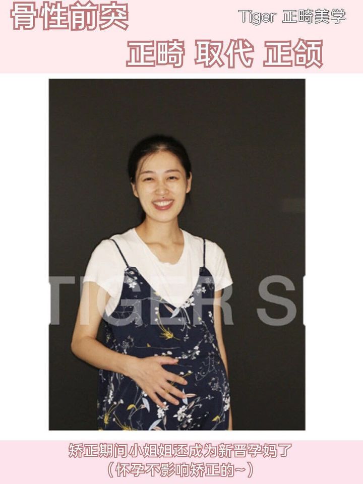 隐适美矫正网上为什么这么便宜,隐适美矫正会不会比预期的快