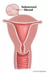 子宫肌瘤出现哪些应警惕癌变可能,子宫肌瘤是怎么引起的会癌变吗