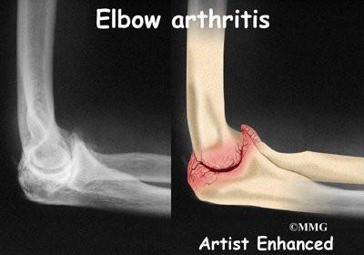 “医生，我胳膊肘伸不直了，还用不了筷子了，我是怎么了啊？”