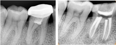 牙齿做根管治疗后补牙多少钱一颗,为什么要做根管治疗不能直接补牙