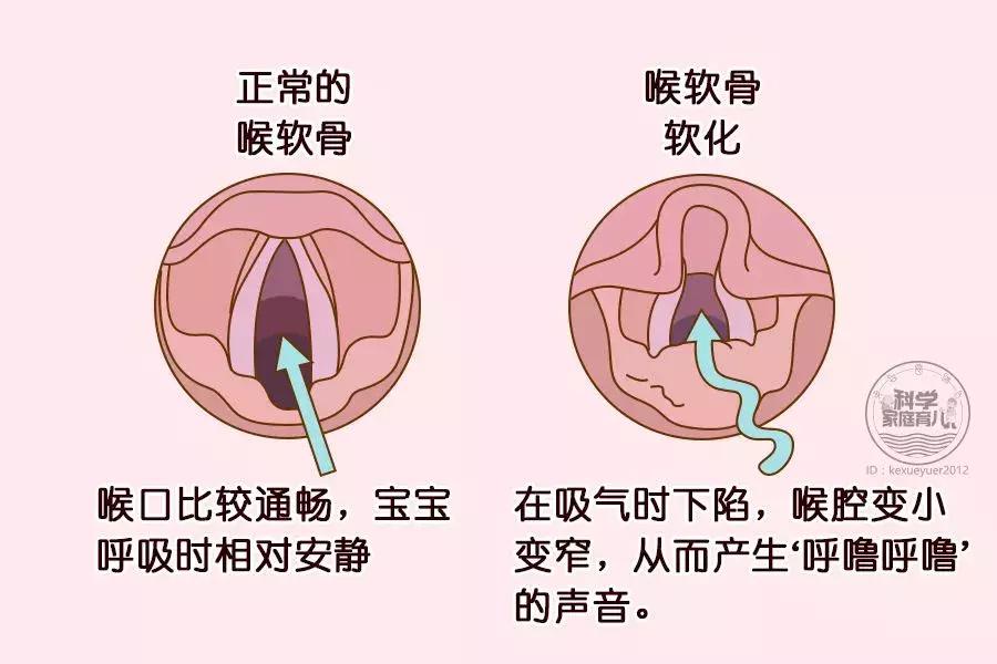 宝宝吃了止咳化痰的药咳嗽更厉害,小孩咳嗽快速止咳雾化用药