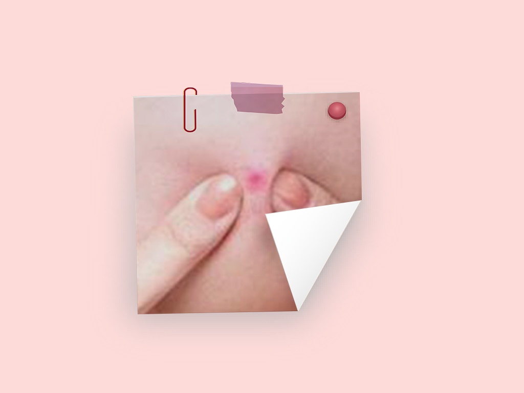 闭合粉刺到底怎么根治,闭合性粉刺怎样用日常方法处理