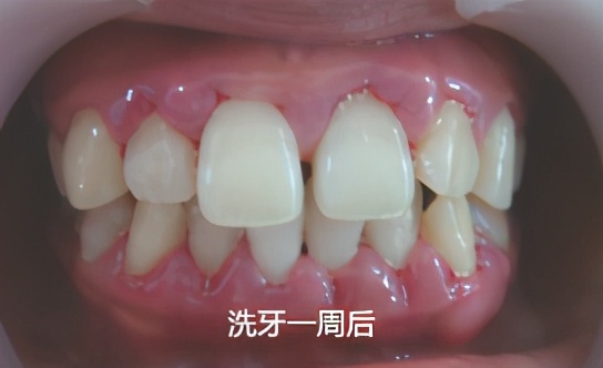 蛀牙与牙周炎哪个更严重,慢性牙周炎口腔健康的头号杀手