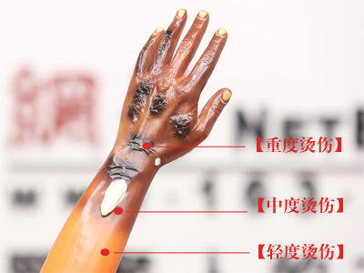 烧烫伤小科普,高温烫伤处理方法以及关注事项