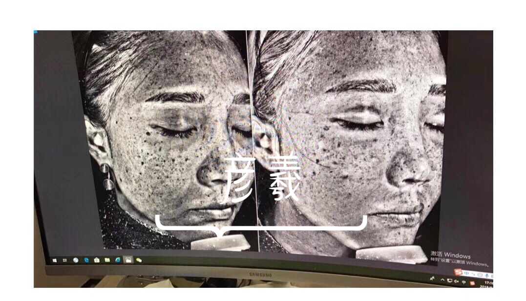 国内医美针剂为什么这么贵,医美国内外区别