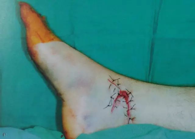 刀口闭合需要多久,伤口闭合除了缝针还有什么方法