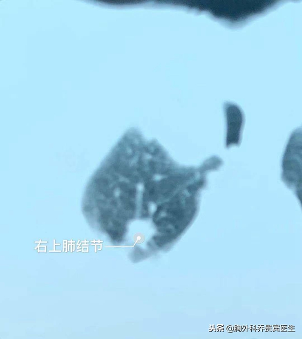 74岁老人肺结节恶性怎么治疗,75岁老人肺部有结节怎么办