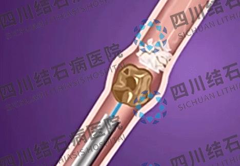 双肾结石手术后五月后又有新结石,女子右肾取出一盘结石