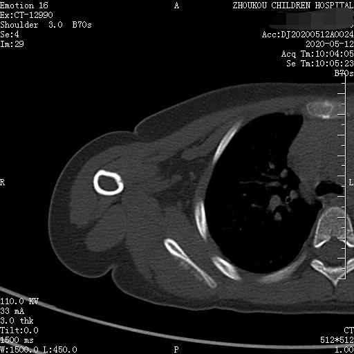 家长要警惕孩子腺样体面容,家长应该警惕孩子出现异常