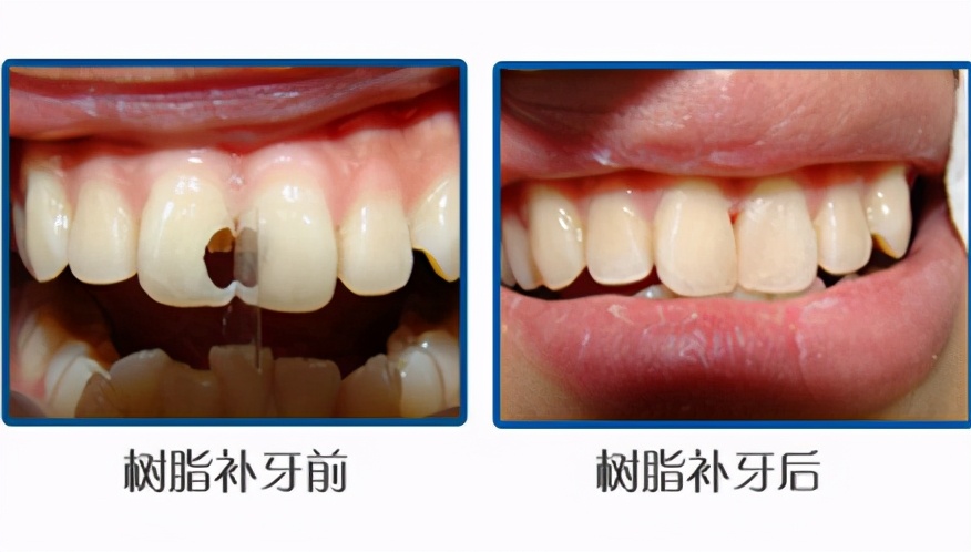 牙齿缺损修复的方法和技巧,牙齿楔状缺损修复图片