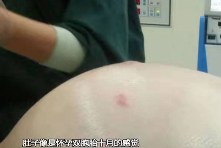 61岁阿姨肚凸如身怀六胞胎，没想到是11年前留下的“祸根”