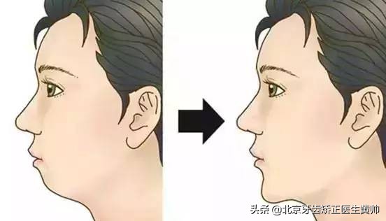 橡胶牙套矫正后脸型变化,戴过牙套的脸恢复了吗