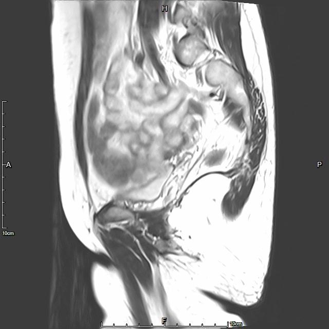 子宫腺肌症「不死的癌症」——介入栓塞来帮忙