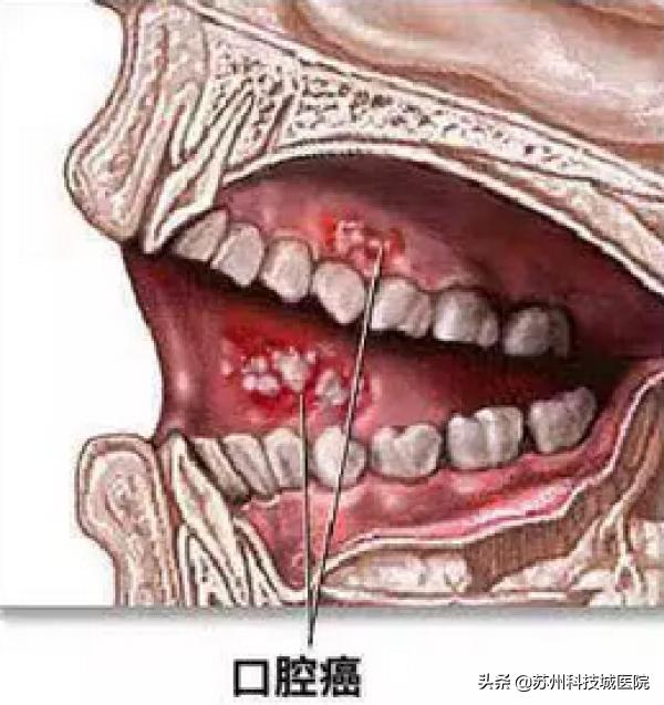 口腔也会得癌？你的这几个习惯是“致命”诱因