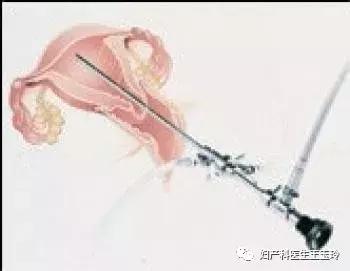 输卵管通而不畅通过腹腔镜咋检查,左侧输卵管通畅右侧通而不畅