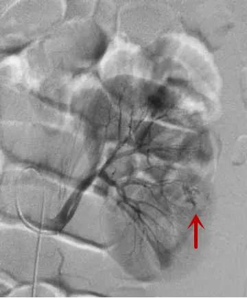 一产妇手术台上大出血死亡,一产妇大出血急需血小板去世