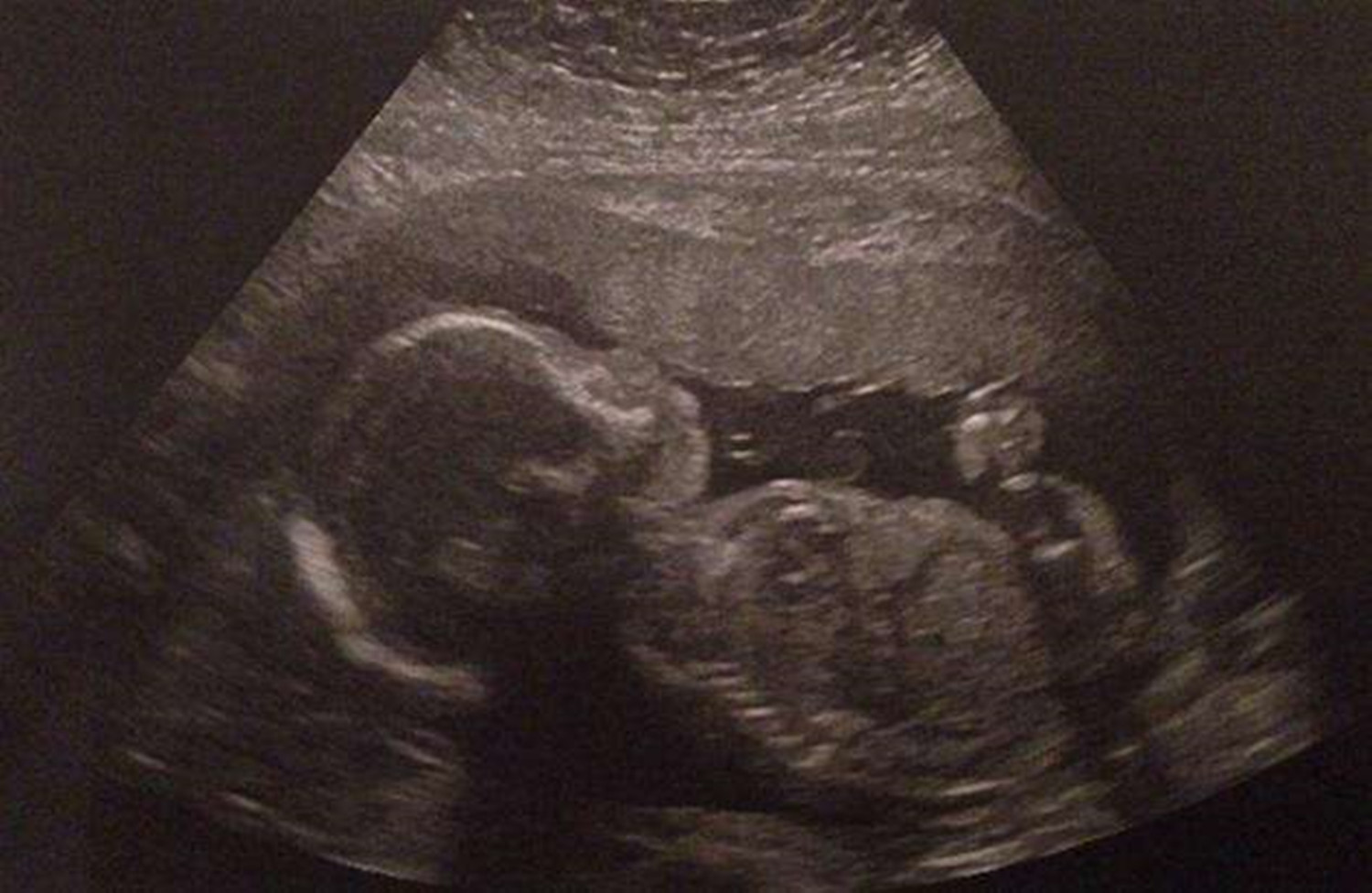 孕期胎动不活跃正常么,孕期胎动不明显是因为懒吗