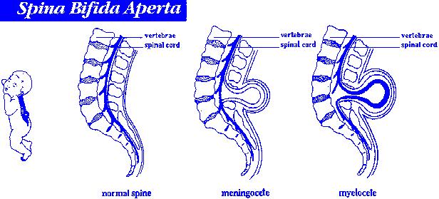 后背脊柱中间凸是正常的吗,脊柱裂腰左侧凸起是怎么回事