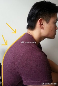 肩胛骨突出矫正的方法,体态矫正脊柱前凸