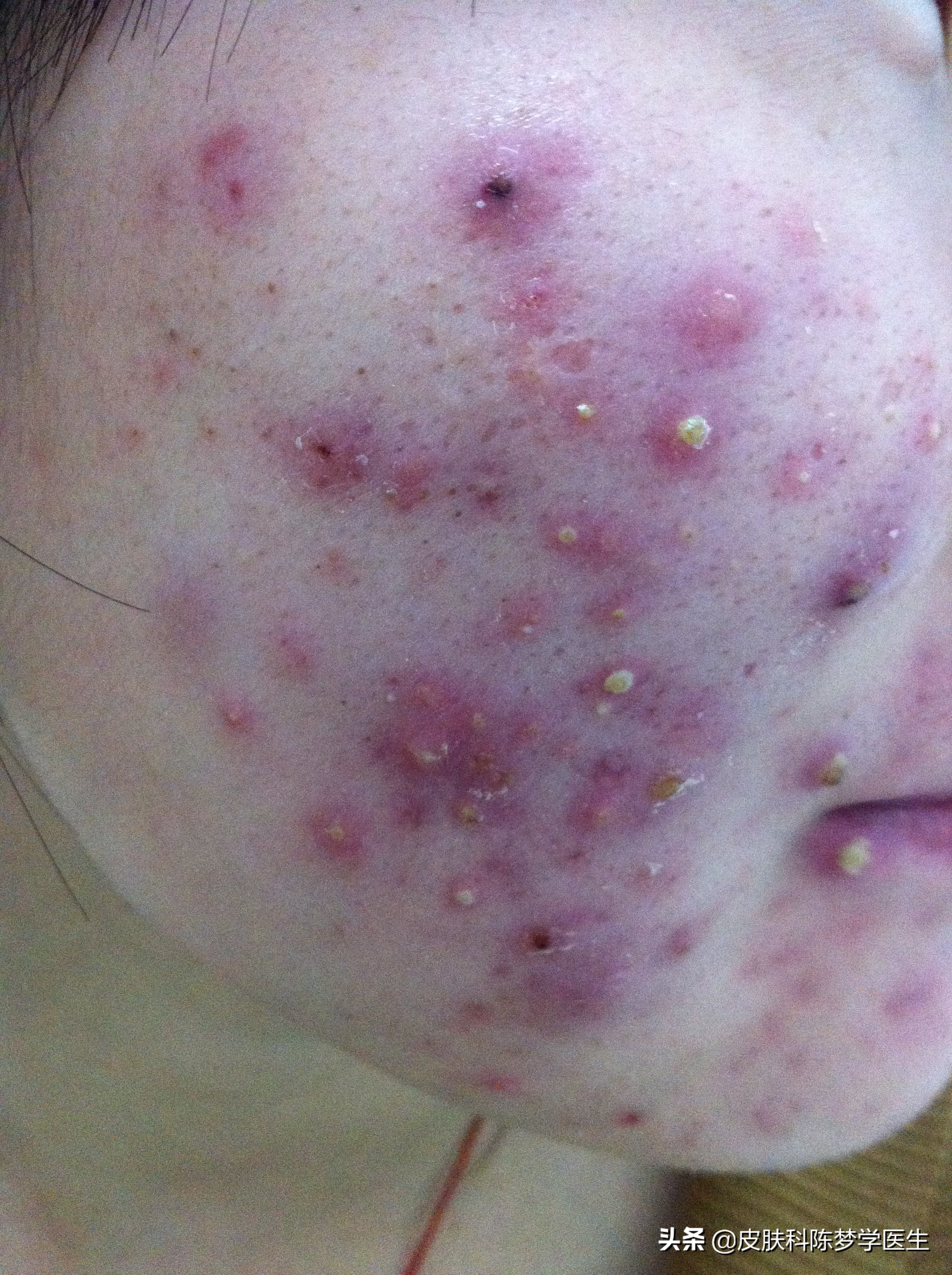 青春痘治疗最佳中成药,青春痘最好的治疗方案