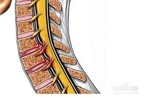 腰椎骨质增生吊单杠有作用吗,腰椎3-5节骨质增生严重吗
