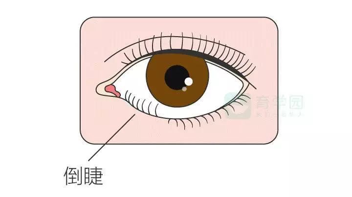 孩子频繁眨眼，是病吗？要不要治？
