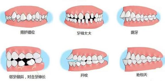 正畸矫正知识,正畸知识科普视频