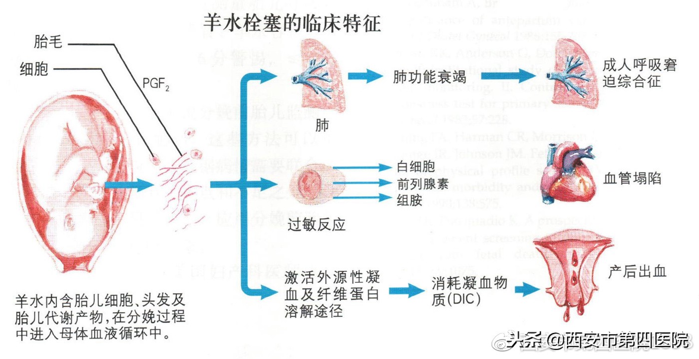 五种孕妇要当心羊水栓塞,什么产妇会出现羊水栓塞