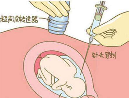 羊水穿刺真的那么可怕？先别急着紧张，看你符合标准吗？