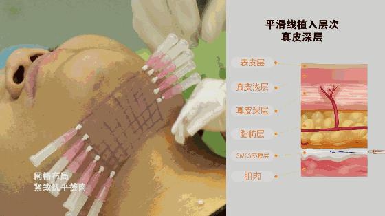 线雕鱼骨线跟普通大v线的区别,v提拉和线雕有什么区别