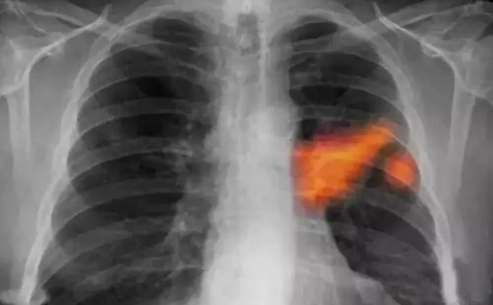 慢性气管炎最常见并发症,急性气管支气管炎主要表现症状