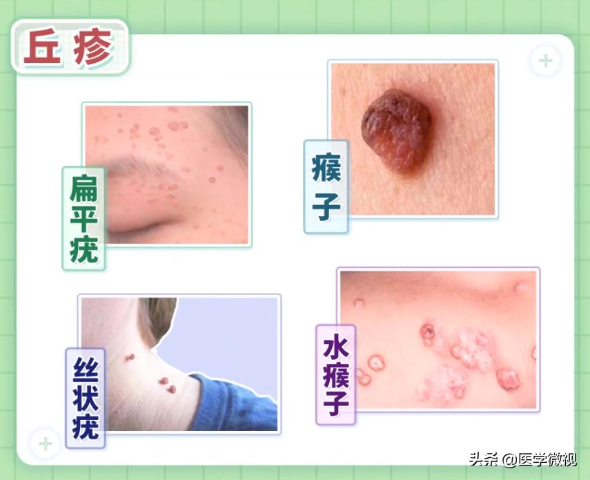 长得像瘊子一样的痘痘怎么回事,身上出类似瘊子的痘痘是什么原因