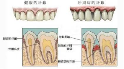 牙缝大一吃东西就塞得痛怎么办,牙缝越剔越大是真的吗
