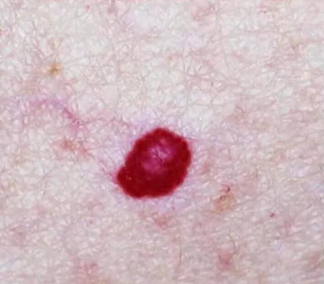 乙肝患者皮肤发黄还意味着什么,乙肝患者皮肤出现红点