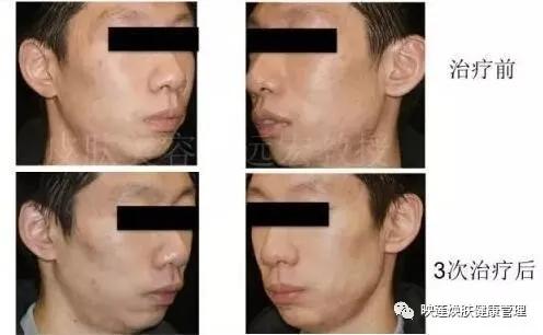 脸部皮肤严重缺水怎么调理,皮肤油光暗沉怎么办