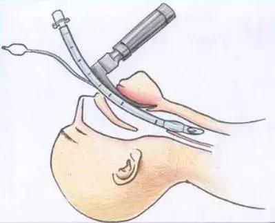 小孩先天性食道被塞什么引起的,一岁女童胃部被撑破