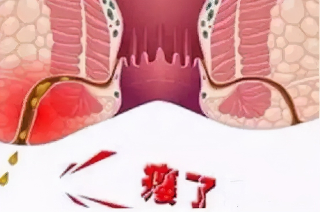 肛瘘手术治愈当兵训练有影响吗,肛瘘手术后遗症有哪些