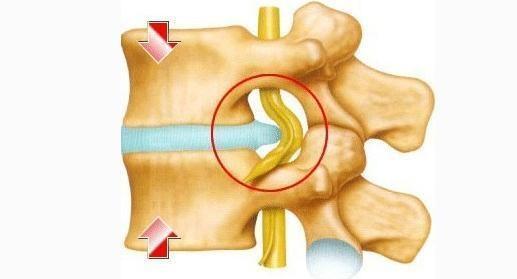 阶梯治疗！腰间盘突出你需要了解的真相