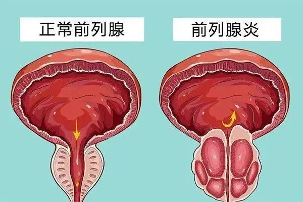前列腺增生怎么改善或者预防,年轻人前列腺结石的预防方法