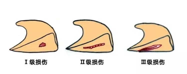 半月板损伤康复,儿童半月板损伤