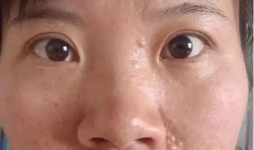 长了这么多年汗管瘤，你还以为是脂肪粒？