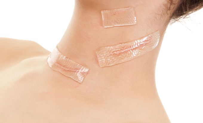 瘢痕疙瘩发病原因,皮肤瘢痕症