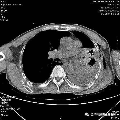 肺手术后乳糜胸是医疗事故吗,肺部切除后乳糜胸治好了