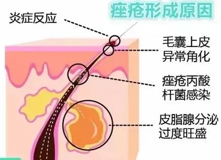 果酸换肤祛痘坑,痘肌必看果酸换肤详细指南