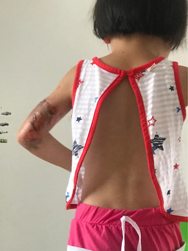 当女儿被严重烫伤疼痛难忍,幼儿园女孩被烫伤治疗过程
