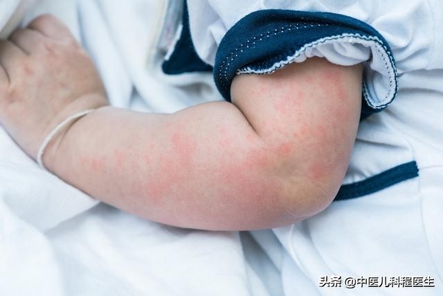 宝宝湿疹怎么治疗才好,宝宝湿疹如何内调