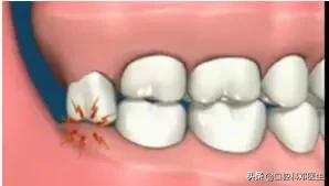 智齿很小一个自己就拔掉了,稍微晃动的智齿拔掉很快吗